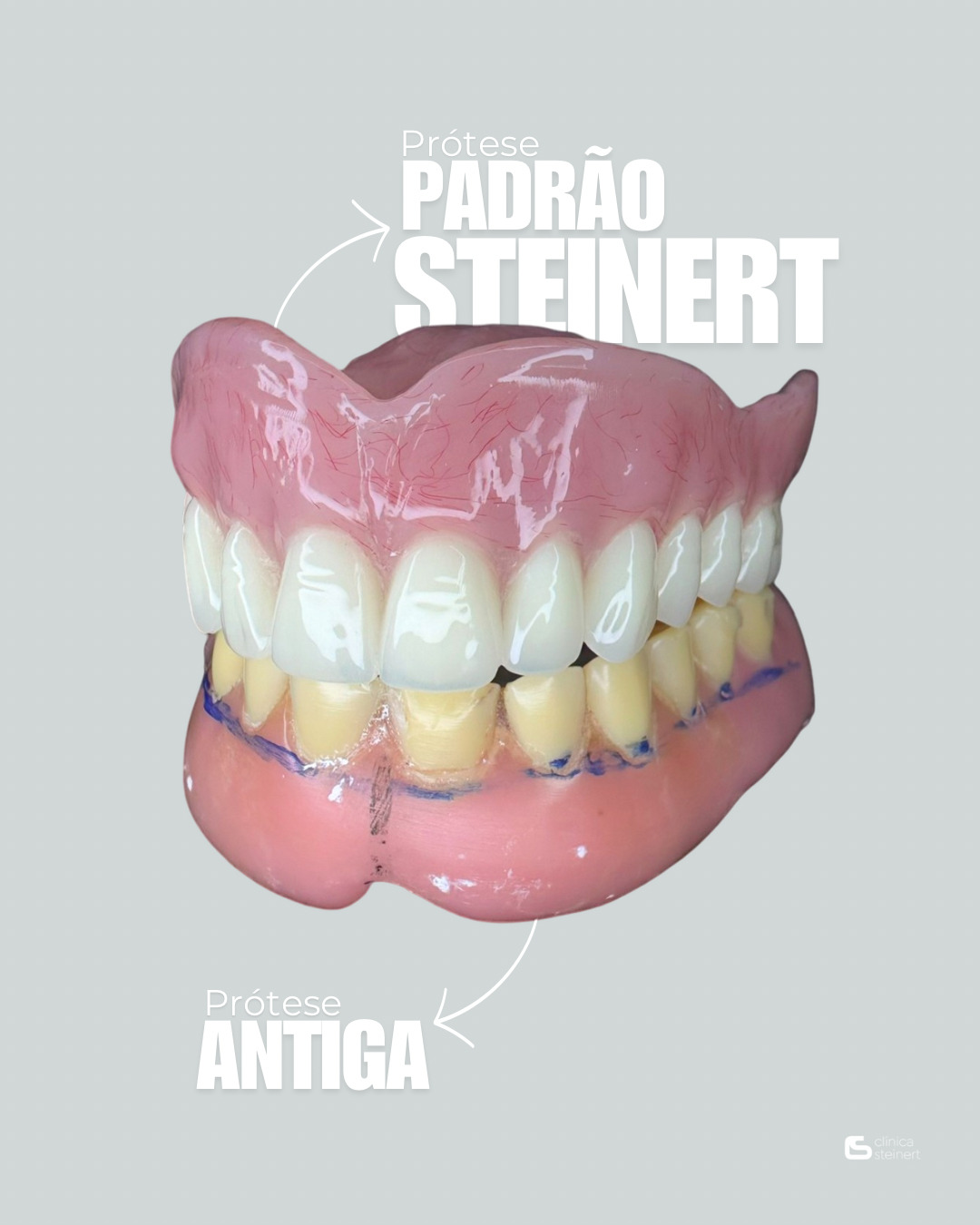 Implantes